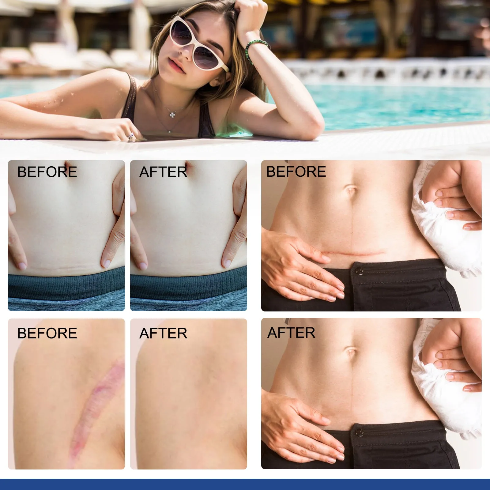 ALIVER Silicone Scar Sheets, Silicone Scar Tape-1.6”x120”, Scar Removal Strips for Acne Scars C-Section & Keloid Surgery Scars Sheets - 6-8 Month Supply